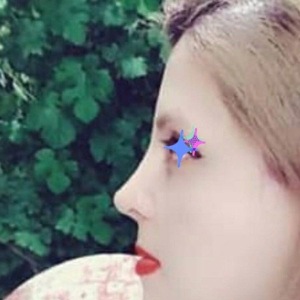 جراحی-بینی-14