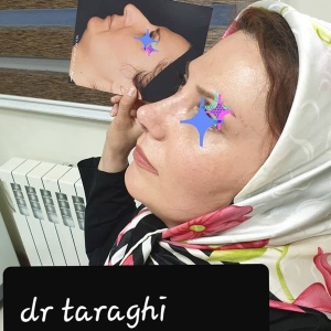 جراحی-بینی-20