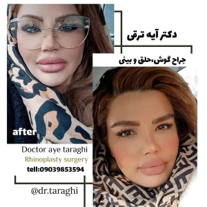 جراحی-بینی22