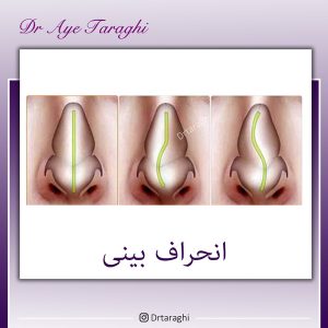 انحراف بینی