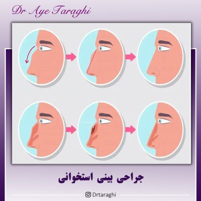 جراحی بینی استخوانی