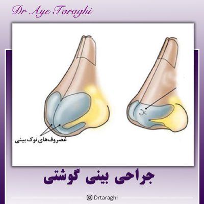 جراحی بینی گوشتی