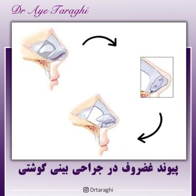 جراحی بینی گوشتی