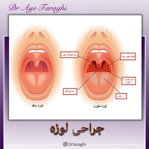 جراحی لوزه