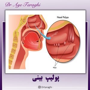 پولیپ بینی