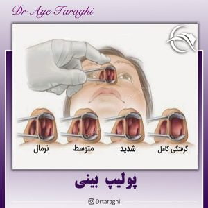 پولیپ بینی