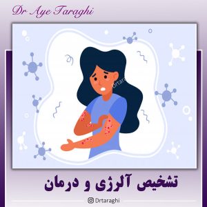 آلرژی