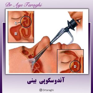 آندوسکوپی بینی