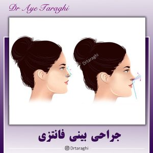 جراحی بینی فانتزی