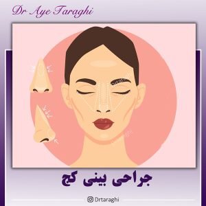 جراحی بینی کج