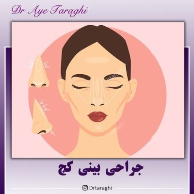 جراحی بینی کج