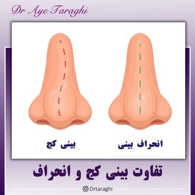 جراحی بینی کج
