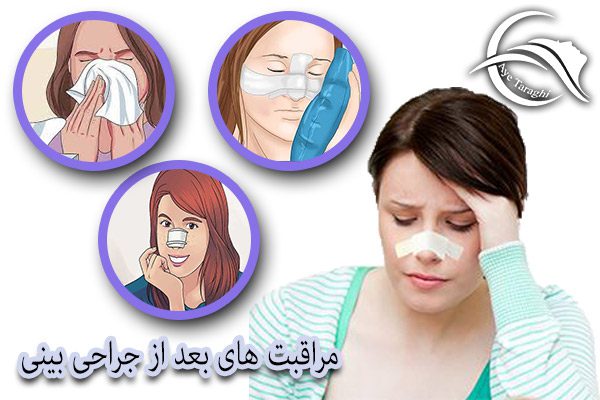 مراقبت های بعد از جراحی بینی