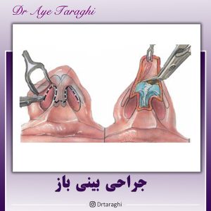 جراحی بینی باز