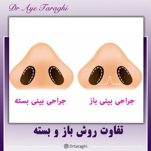 جراحی بینی باز