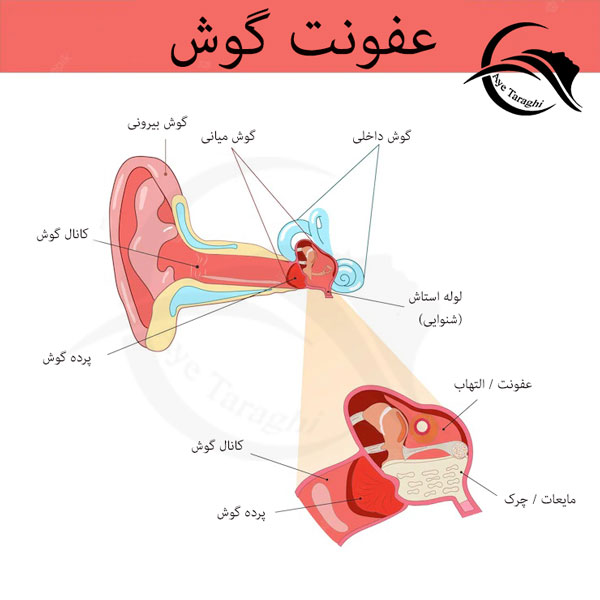عفونت گوش