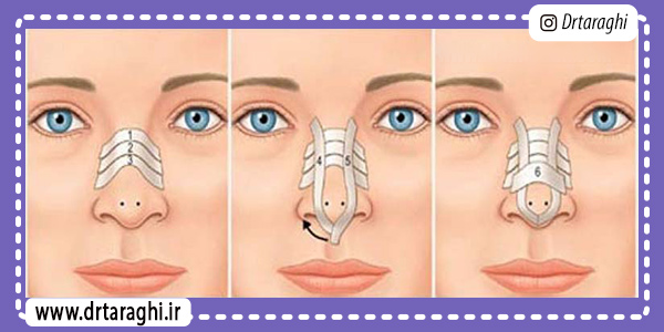 چسب زدن به بینی بعد از جراحی