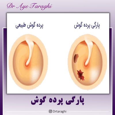 پارگی پرده گوش - دکتر آیه ترقی