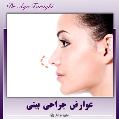 عوارض جراحی بینی - دکتر ترقی
